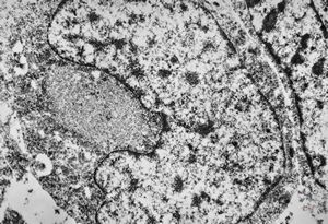 F, 85y. | Merkel cell tumor F, 85y. | Merkel cell tumor